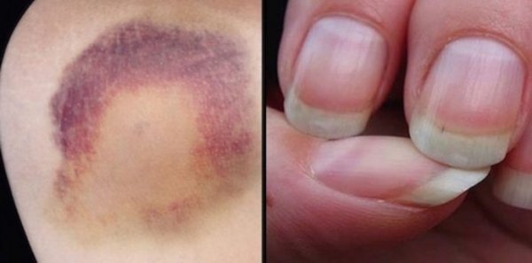 15 распространенных симптомов рака у женщин, которые часто игнорируются!
