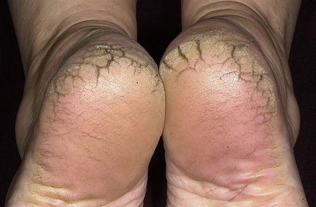 5 скрытых БОЛЕЗНЕЙ, которые сопровождаются трещинами на пятках
