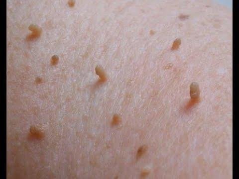 Как избавиться от папиллом в домашних условиях: 10 проверенных способов