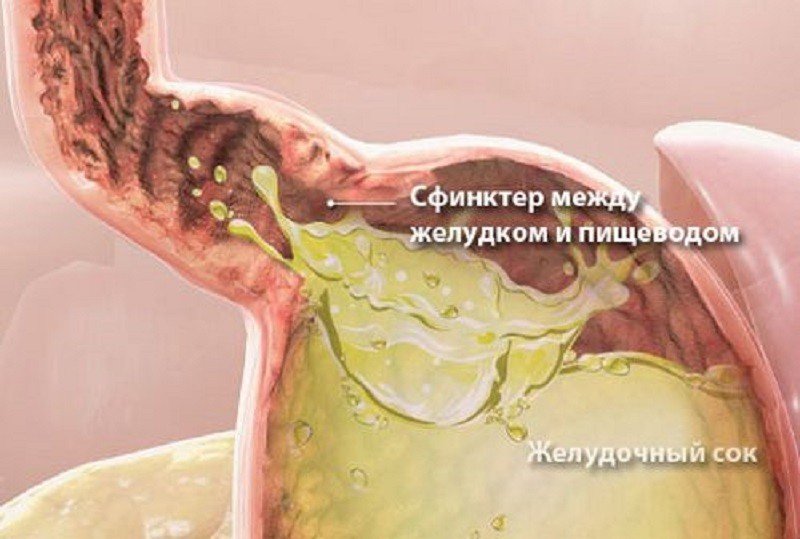 6 продуктов-огнетушителей: Как избавиться от изжоги
