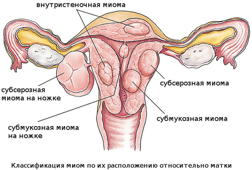 За 1 месяц избавиться от кисты и миомы помогут 3 напитка